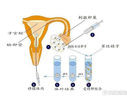 赠卵试管婴儿优惠补贴政策